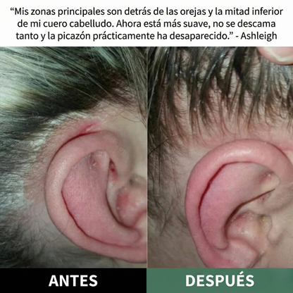 Exfoliante Capilar Natural 'Derma-Calm' con Ácidos Frutales para Psoriasis, Descamación y Alivio del Picor