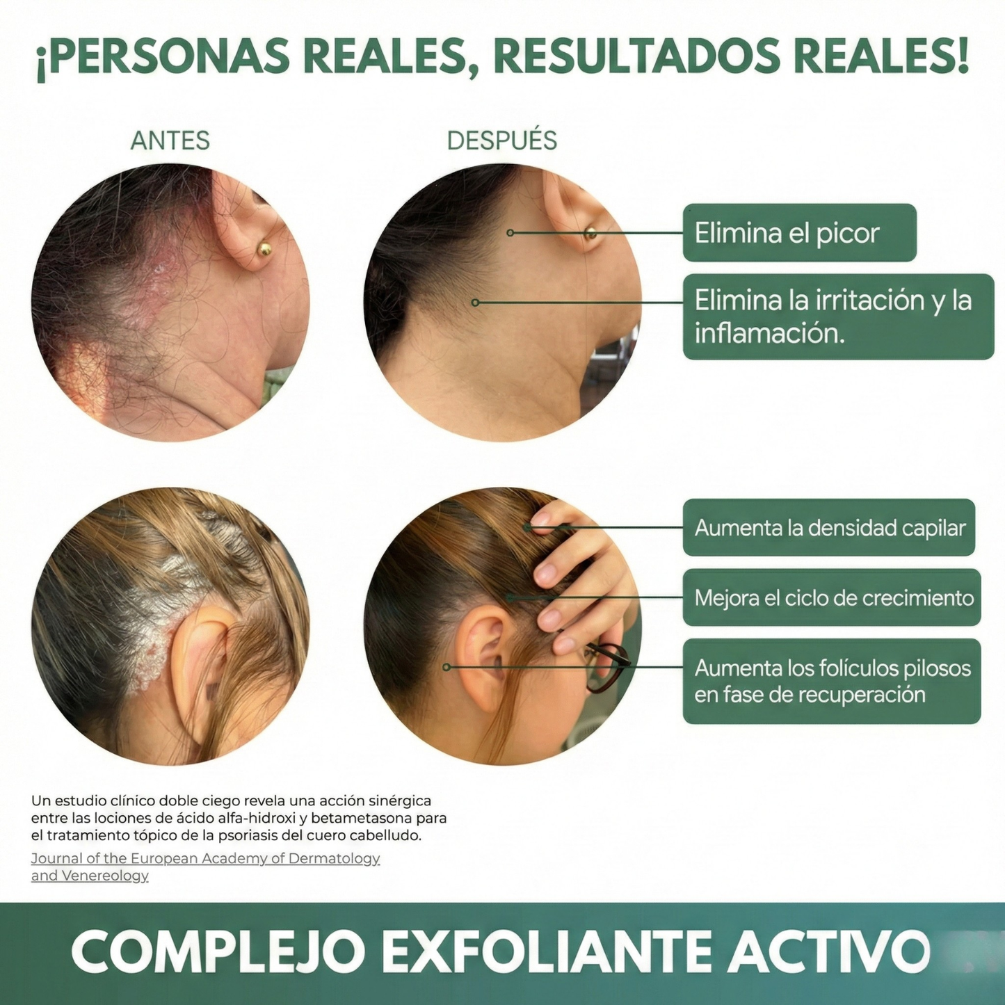 Exfoliante Capilar Natural 'Derma-Calm' con Ácidos Frutales para Psoriasis, Descamación y Alivio del Picor