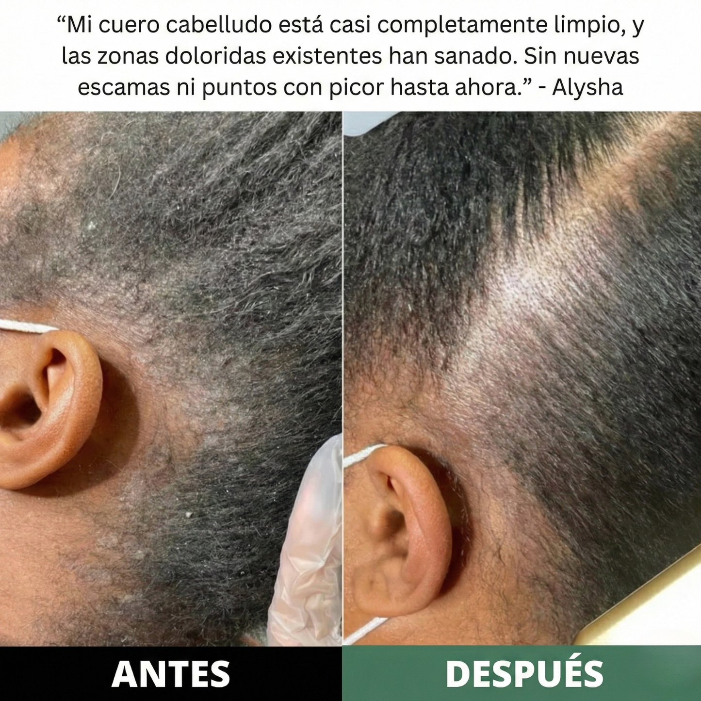 Exfoliante Capilar Natural 'Derma-Calm' con Ácidos Frutales para Psoriasis, Descamación y Alivio del Picor